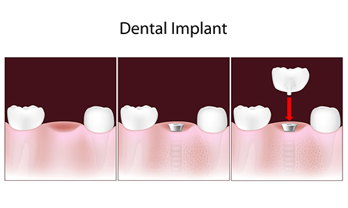dental implants in commack