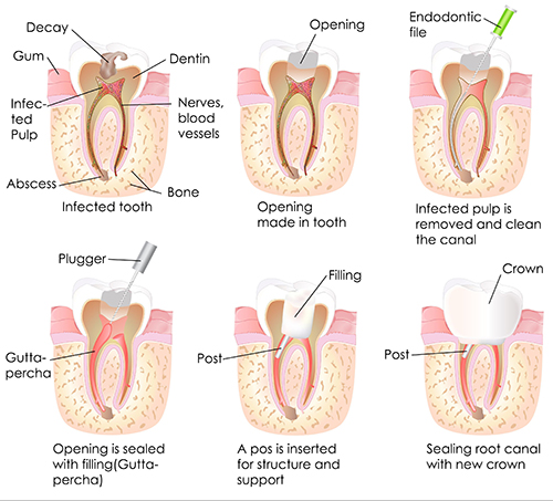 root canal in commack